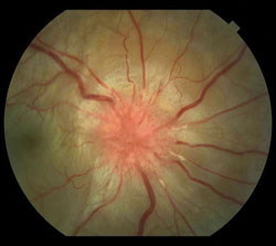 Figure 1. Fundus photo right eye