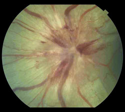 Figure 2. Fundus photo left eye