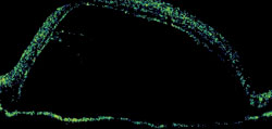 Figure 3. OCT right eye