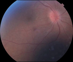 Figure 5a. Follow-up fundus photo