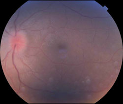 Figure 5b. Follow-up fundus photo