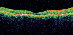 Figure 6. Follow-up OCT right eye