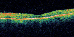 Figure 7. Follow-up OCT left eye