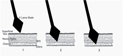 Figure 1. Schematic representation of the cross-sectional posterior eye wall