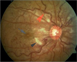 Figure 3. Fundus photo of an ischemic central retinal vein occlusion