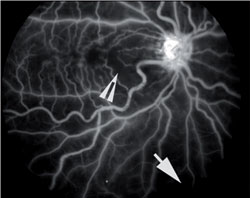 Figure 4. Fluorescein angiogram of the ischemic central retinal vein occlusion