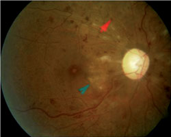 Figure 5. Fundus view, 2 weeks after revascularization