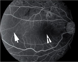 Figure 6. Corresponding fluorescein angiogram