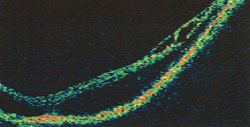 OCT scans of myopic foveoschisis