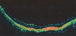 OCT scans of myopic foveoschisis