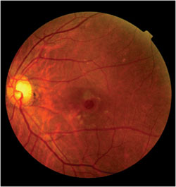 Fundus photo