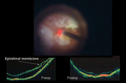 Intraoperative photo of treating a high myope with foveoschisis (using laser)