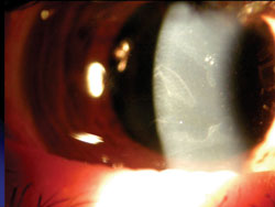 Figure 1. Epithelial basement membrane dystrophy