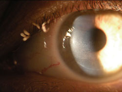 Figure 2. This patient experienced severe dry eye