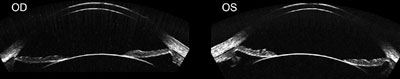 Right and left eyes of the same patient