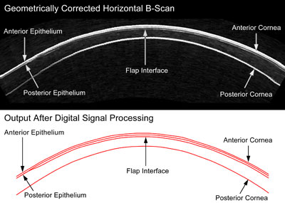 Artemis B-scan of the cornea 1 year after LASIK