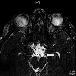 Figure 2. T2-weighted MRI 