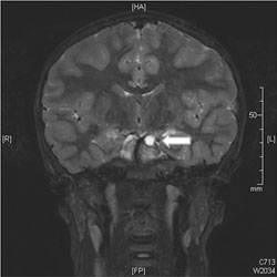 Figure 2. T2-weighted MRI 