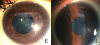 Figure 2. Clinical photograph showing patchy scarring