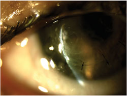 Figure 2. Slit-lamp photograph on day 1 after the surgical repair