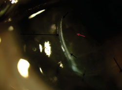 Figure 3. The site of stromal bed perforation is indicated by the short red arrow