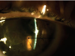 Figure 4. Long black arrow identifies LASIK flap defect 