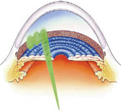 Figure 2. The laser energy is adapted to the degree of pigmentation of the trabecular network (energy between 0.3mJ and 1.6 mJ). The corresponding selected initial energy is increased stepwise by 0.1 mJ until champagne bubbles form. 