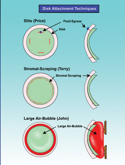 Figure 1: Schematic representation of three surgical techniques to increase donor corneal disc attachment to the recipient cornea.