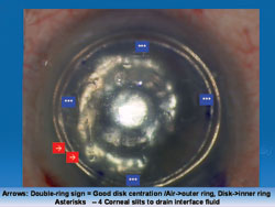 Figure 2: Intraoperative photograph showing four slits (asterisks), one in each quadrant to drain any interface fluid and increase adherence of the disc to the recipient corneal stroma.