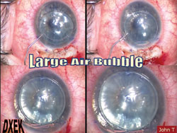 Figure 3: A large air bubble is used to attach the donor corneal disc to the inner stromal surface of the recipient cornea.