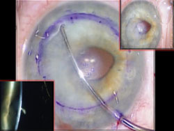 Figure 4: Descemetorhexis using the John Dexatome DSAEK spatula (ASICO); (inserts) Intraoperative broad and slit-lamp views displaying the corneal stromal edema. 