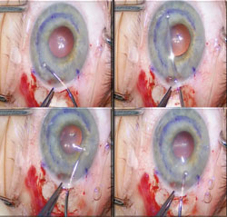 Figure 5: Band of peripheral roughening of the recipient corneal stroma within the circular epithelial mark.