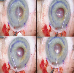 Figure 7: Four-patch (nasal, superior, temporal and inferior)