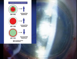 Figure 8: Broad slit-view of a large air bubble pushing the donor corneal disc against the host corneal stroma.