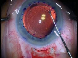 Stripping of Descemet's membrane