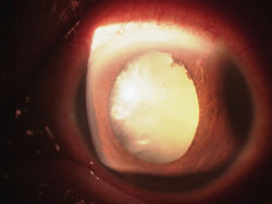 Figure 1. A white cataract often has a dense nuclear core