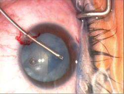 Figure 2. By keeping the anterior chamber highly pressurized with a viscoadaptive device