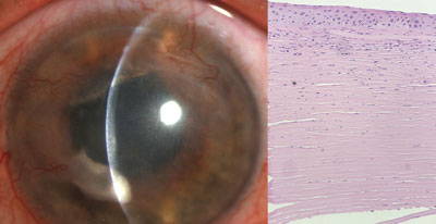 Clinically quiescent herpes simplex virus keratitis