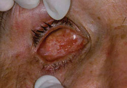 Figure 4. Final healed socket 