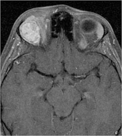 Figure 2. MRI of the orbit