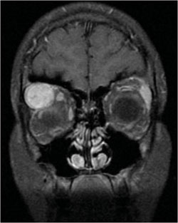 Figure 3. MRI of the orbit