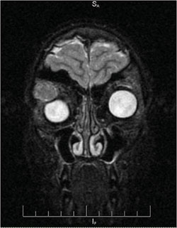 Figure 4. MRI of the orbit