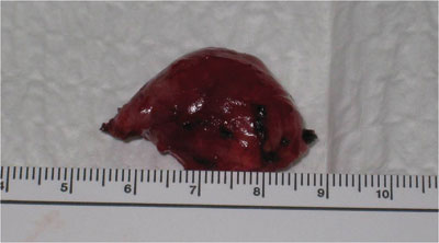 Figure 5. The lesion was removed with a craniotomy approach