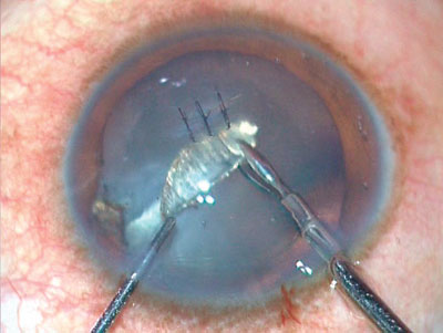 Figure 1. Corneal penetrating trauma 