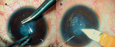 Figures 2A and 2B. A: Corneal perforation repair done with 10-0 nylon. B: Main port made with keratome for cataract removal.