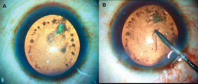 Figures 3A and 3B. A: Siderosis with cataract. B: Capsulorrhexis is completed