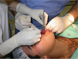 Figure 1. Harvesting oral biopsy