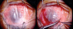 Figure 3. Intraoperative photograph shows extensive ocular surface disease