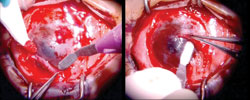 Figure 4. Superficial keratectomy