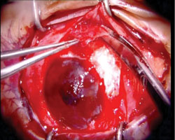 Figure 5. Removal of subconjunctival tissue 